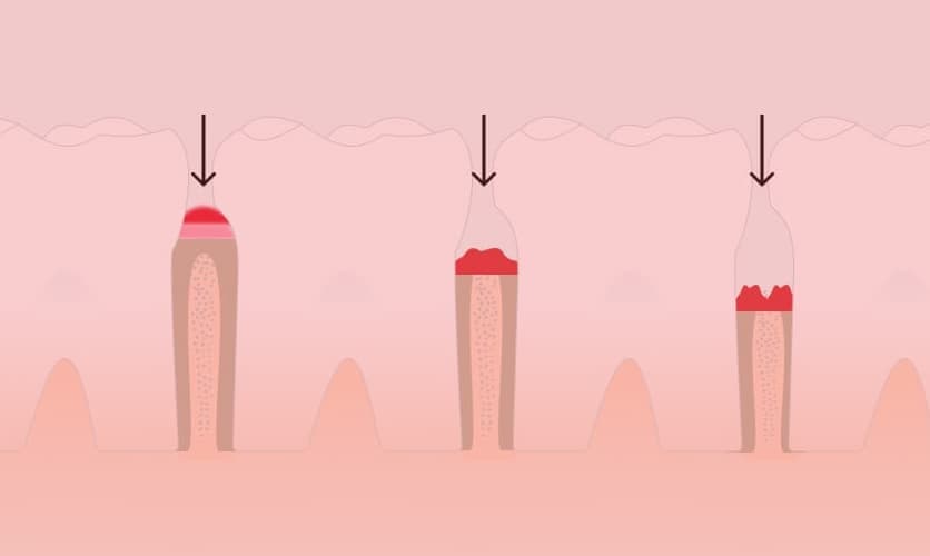 Schematische Darstellung von drei Zähnen mit Zahnfleisch in verschiedenen Stadien einer Entzündung, jedes mit einem Pfeil markiert