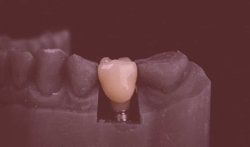 Zahnmodell aus Gips, in dem ein Implantat mit aufgesetzter Krone in der Zahnreihe sitzt